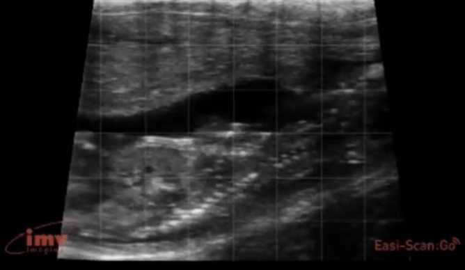 A 64-day-old foetus. We can see the body, in particular the bright glowing bones of the ribs, surrounded by jet black fluid. It’s now longer than the screen but we’re able to measure the width of the ribs, or the head diameter, for an accurate estimate of age.