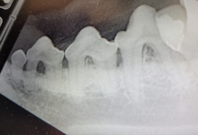 But with an x-ray we found signs of bone loss and furcation - early signs of dental disease.