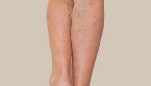 Bruising & Varicose Veins