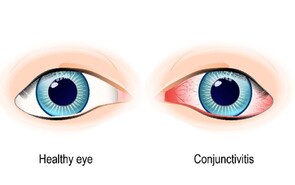 Eye Infections
