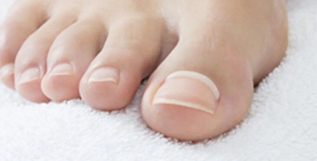 Amazon.com : Pureskin Toenail Renewal - Maximum Strength Nail Repair  Liquid, Toe Nail Support, Health Care for Finger & Toenail, Athlete's Foot,  Ringworm Repair-30ml : Health & Household